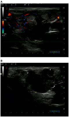 Rare Metastasis of Gastric Cancer to the Thyroid Gland: A Case Report and Review of Literature